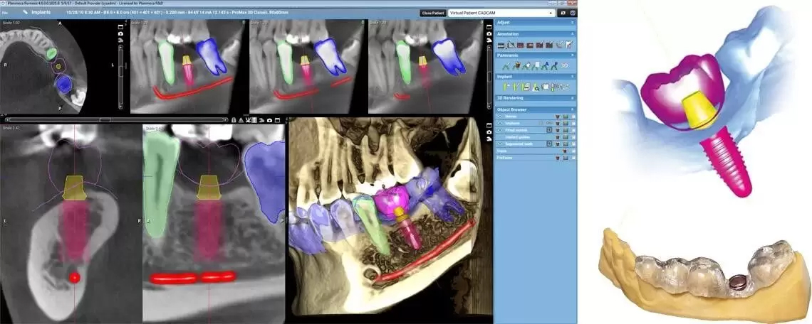 3d-implant-x-ray-example | Colorado Springs, CO