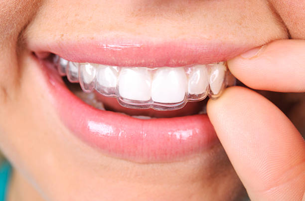 Photograph close up of smile with Invisalign, Colorado Springs, CO